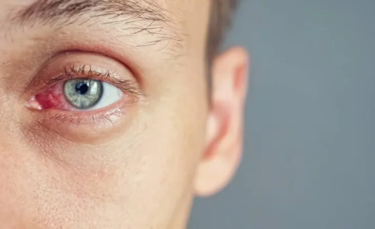 Qué es el Ojo Seco y Cómo Prevenirlo