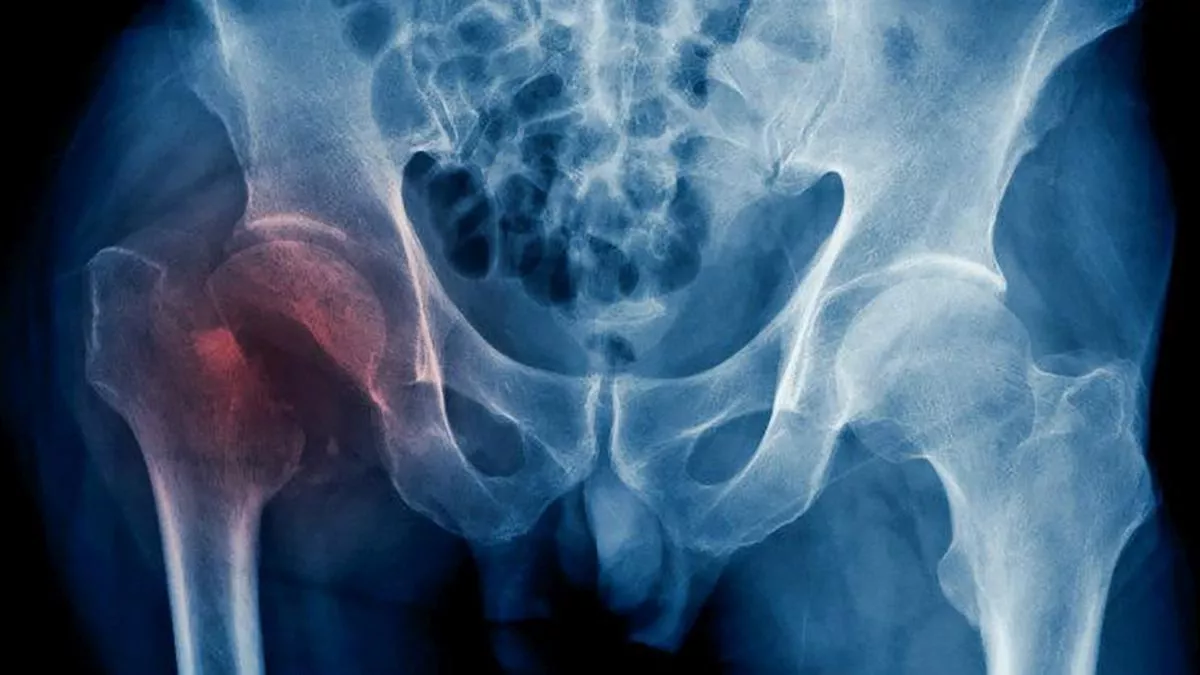 Profesora sufre fracturas de cadera tras caerle portón en mal estado en colegio de Quilpué