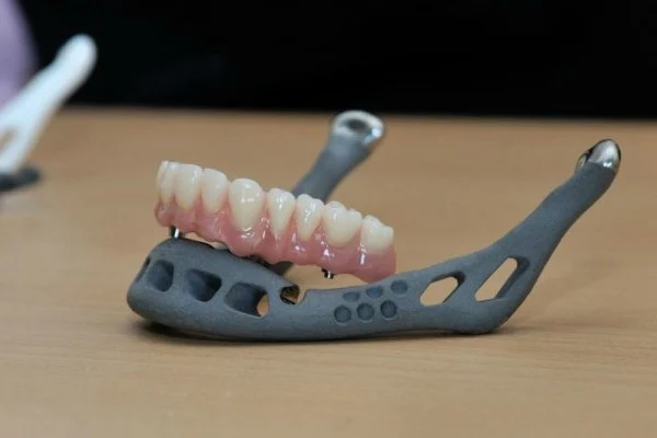 Revolucionario avance en cirugía: implante de mandíbula en 3D hecho de cerámica