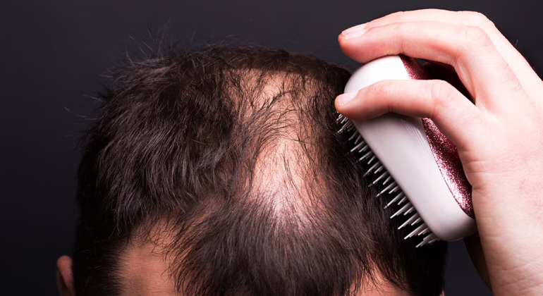 ¿El consumo de alcohol afecta la caída del cabello? Un nuevo estudio lo analiza