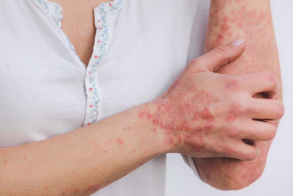 Psoriasis: causas, síntomas y opciones de tratamiento para esta enfermedad crónica de la piel