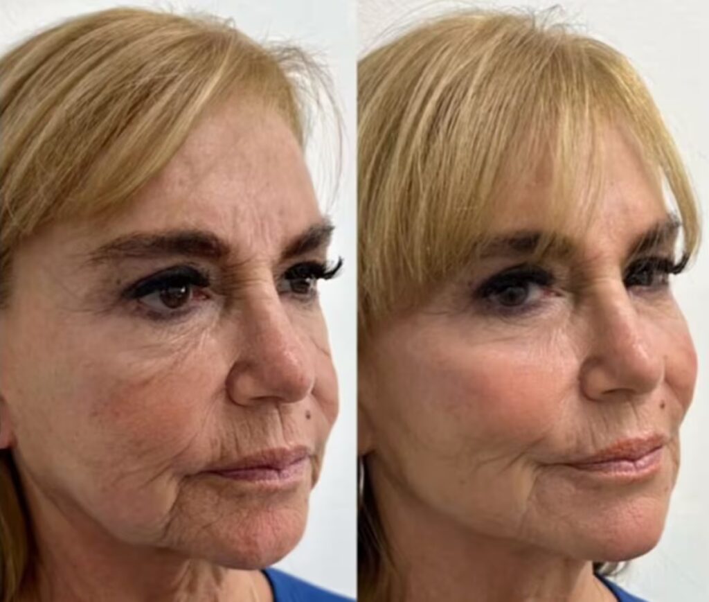 Pilar Cox reaparece con retoque estético y genera polémica en redes sociales