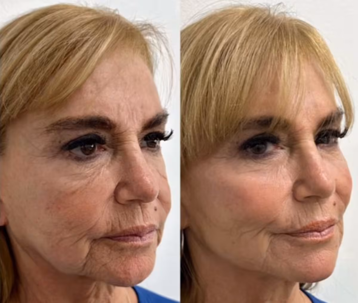 Pilar Cox reaparece con retoque estético y genera polémica en redes sociales