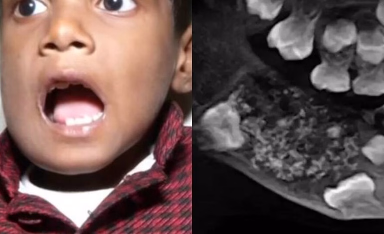 El asombroso caso del niño al que le encontraron 526 dientes en una cirugía en India